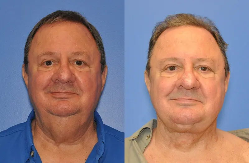 Neck Contouring Before and After Patient 1
