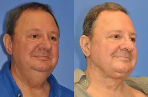 Neck Contouring Before and After Patient Thumbnail 2