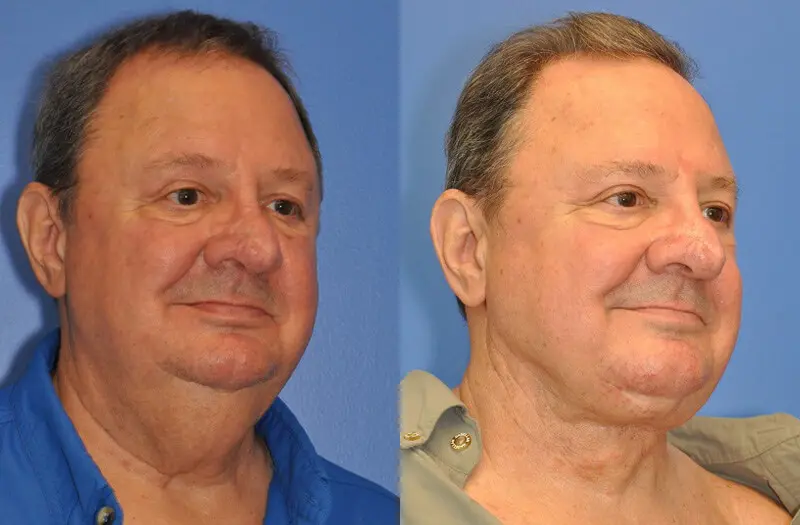 Neck Contouring Before and After Patient 2