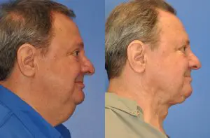 Neck Contouring Before and After Patient Thumbnail 3