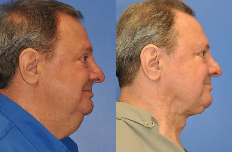 Neck Contouring Before and After Patient 3