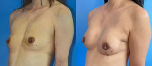 Breast Reconstruction Before and After Patient Thumbnail 3