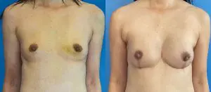 Breast Reconstruction Before and After Patient Thumbnail 1