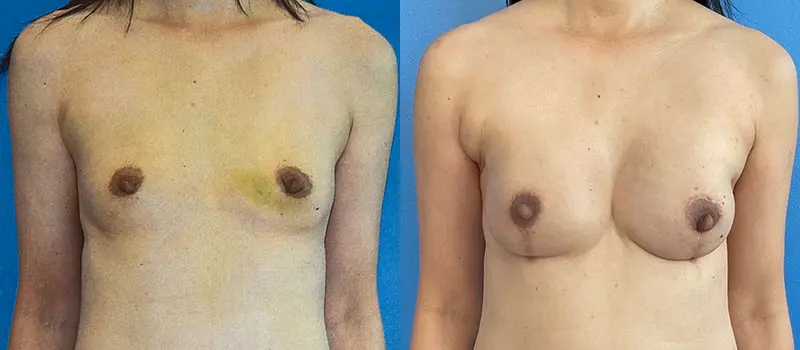 Breast Reconstruction Before and After Patient 1