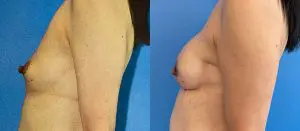 Breast Reconstruction Before and After Patient Thumbnail 2