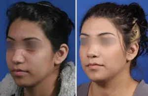 Rhinoplasty Before and After Patient Thumbnail 4