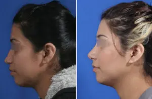 Rhinoplasty Before and After Patient Thumbnail 2