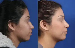Rhinoplasty Before and After Patient Thumbnail 1