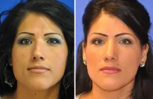 Rhinoplasty Before and After Patient Thumbnail 2