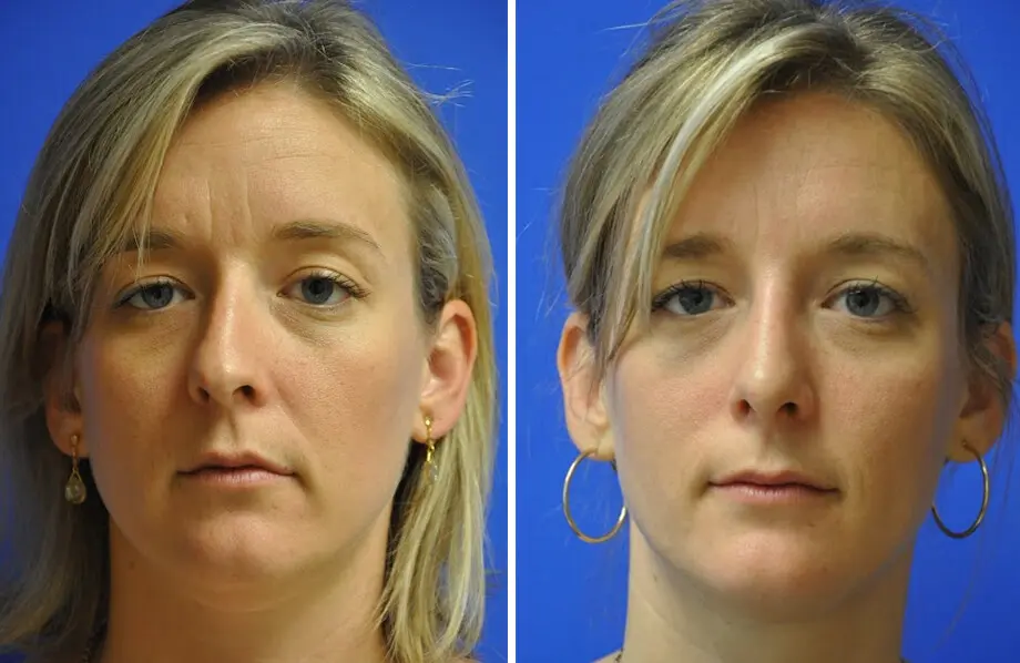 Rhinoplasty Before and After Patient 2