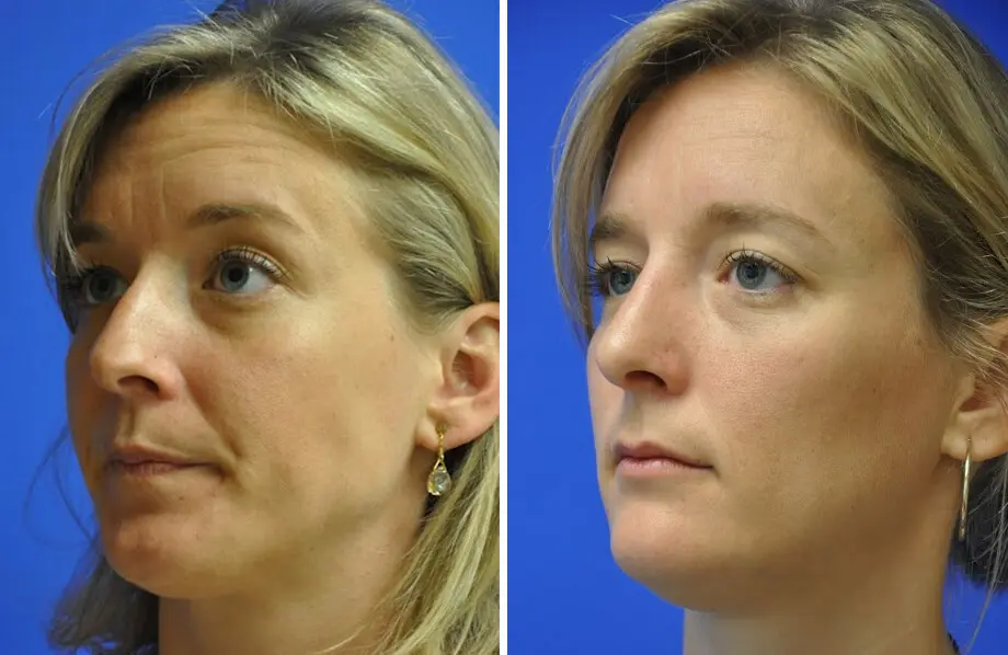 Rhinoplasty Before and After Patient 3