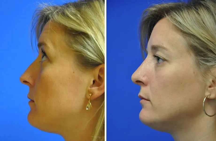 Rhinoplasty Before and After Patient 1