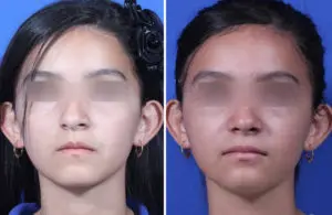 Rhinoplasty Before and After Patient Thumbnail 2