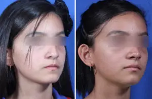 Rhinoplasty Before and After Patient Thumbnail 3