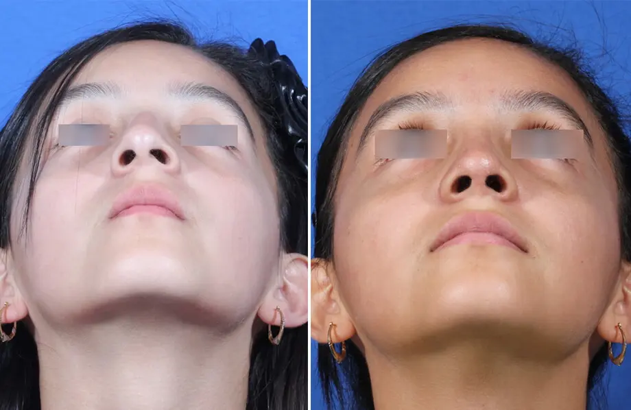 Rhinoplasty Before and After Patient 4