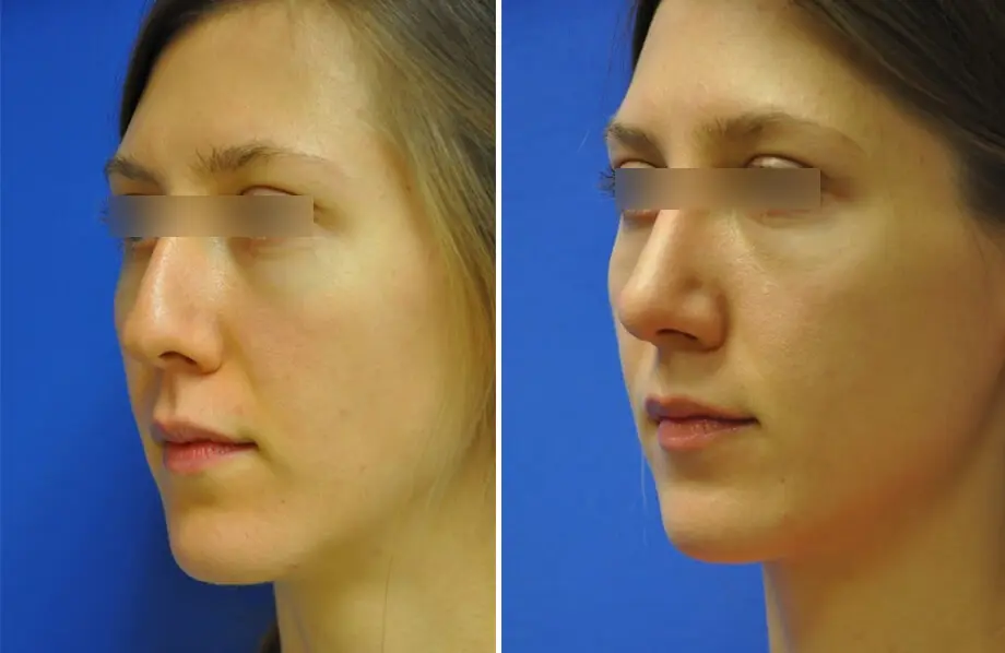 Rhinoplasty Before and After Patient 3