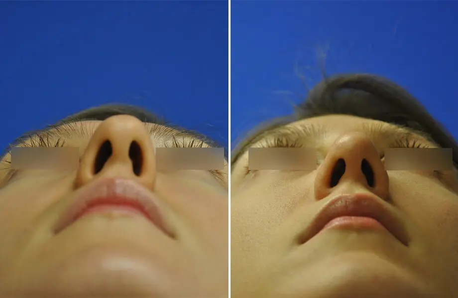 Rhinoplasty Before and After Patient 4