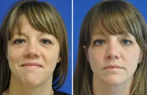 Rhinoplasty Before and After Patient Thumbnail 2