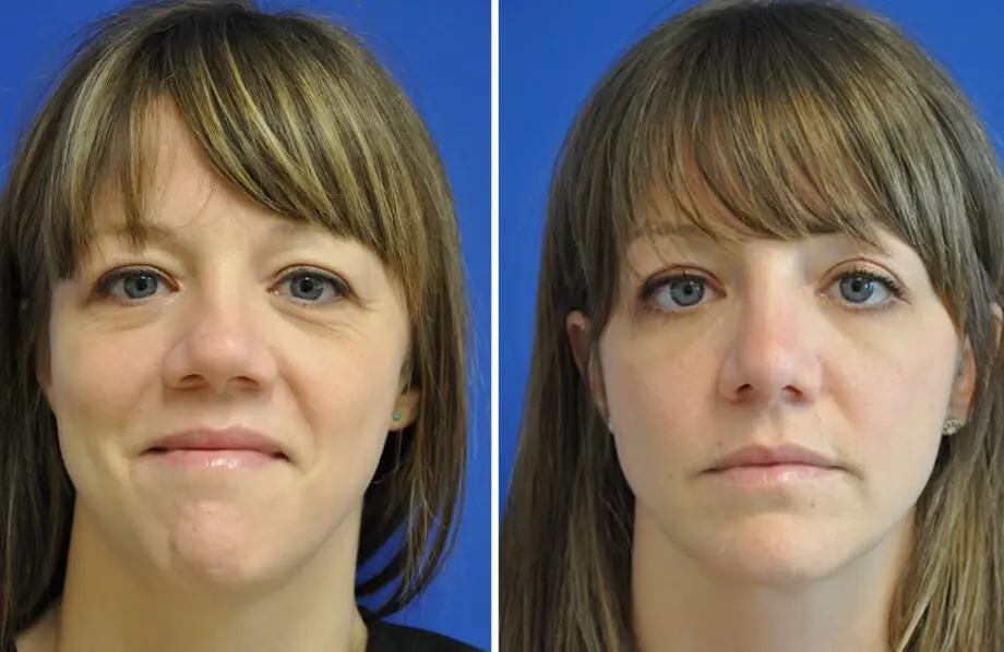 Rhinoplasty Before and After Patient 2
