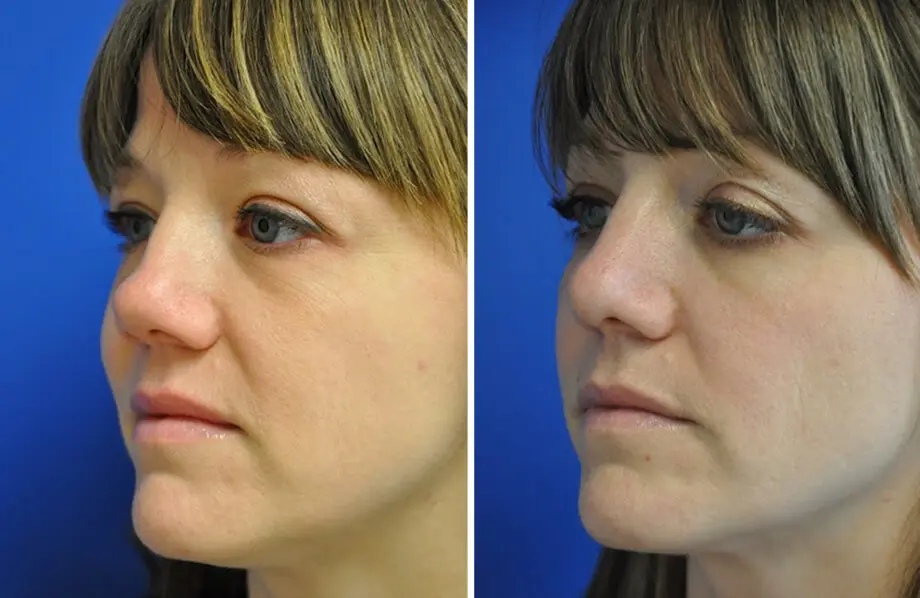 Rhinoplasty Before and After Patient 3