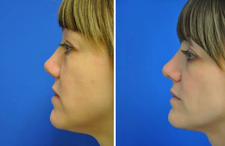 Rhinoplasty Before and After Patient 1