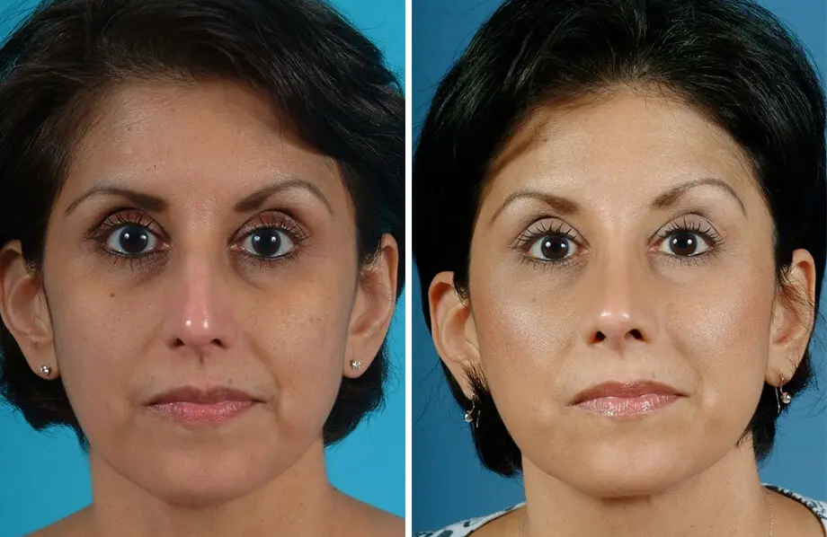 Rhinoplasty Before and After Patient 2