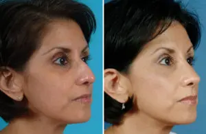 Rhinoplasty Before and After Patient Thumbnail 3