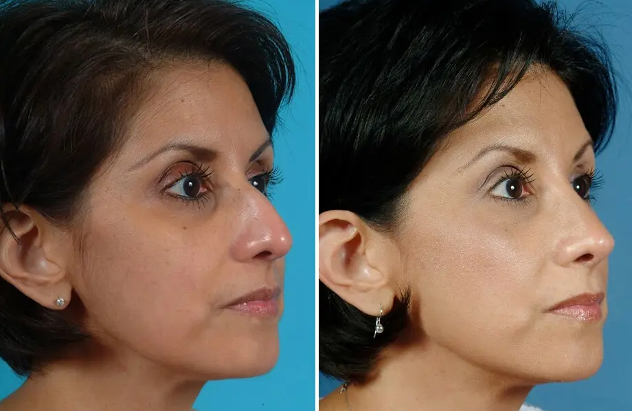 Rhinoplasty Before and After Patient 3