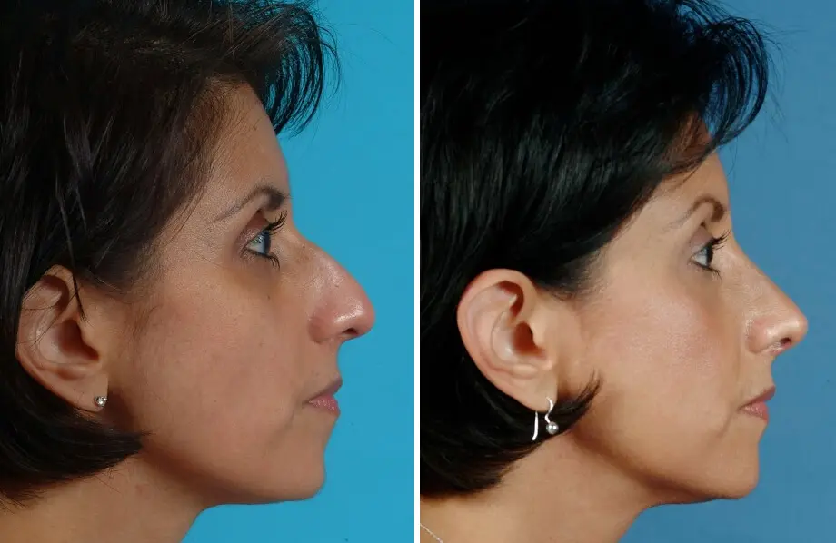 Rhinoplasty Before and After Patient 1