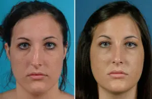 Rhinoplasty Before and After Patient Thumbnail 2