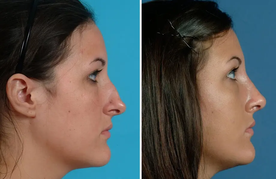 Rhinoplasty Before and After Patient 1