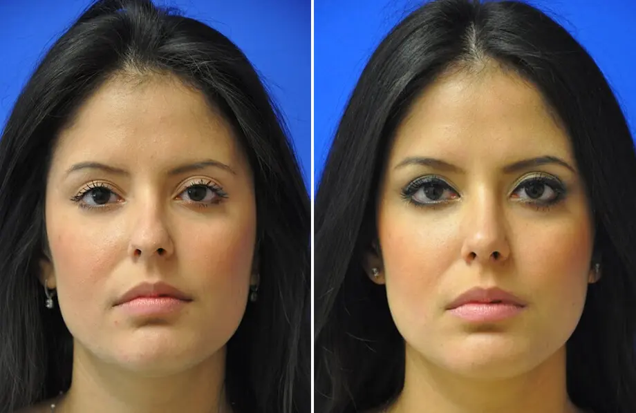 Rhinoplasty Before and After Patient 2