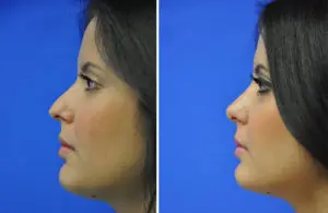 Rhinoplasty Before and After Patient Thumbnail 1