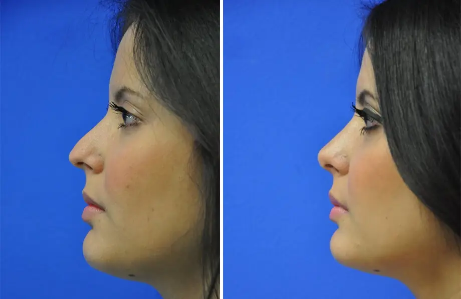 Rhinoplasty Before and After Patient 1