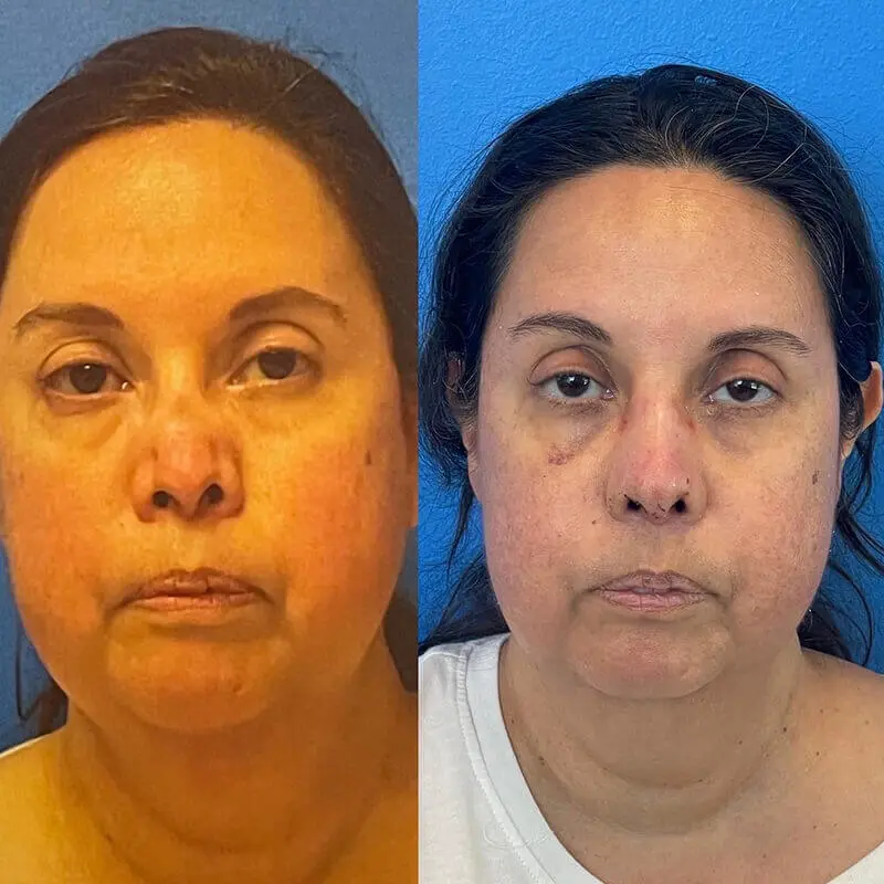 Rhinoplasty Before and After Patient 1