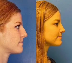 Rhinoplasty Before and After Patient Thumbnail 3