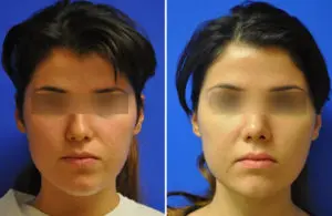 Rhinoplasty Before and After Patient Thumbnail 2