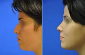 Rhinoplasty Before and After Patient Thumbnail 1