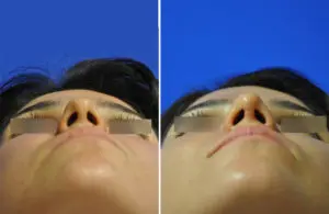 Rhinoplasty Before and After Patient Thumbnail 4