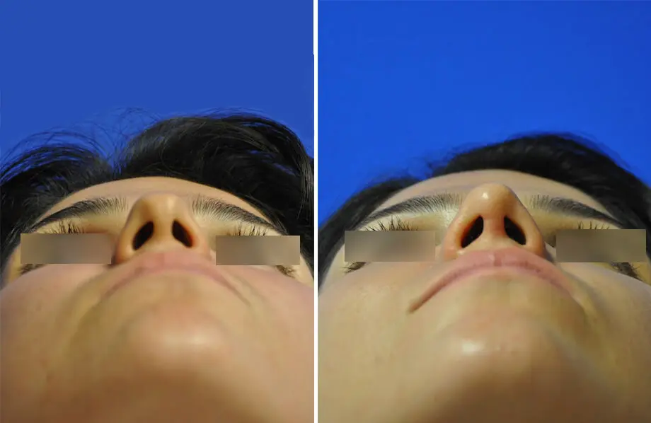 Rhinoplasty Before and After Patient 4