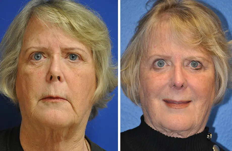 Revision Rhinoplasty Before and After Patient 2