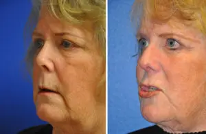 Revision Rhinoplasty Before and After Patient Thumbnail 3