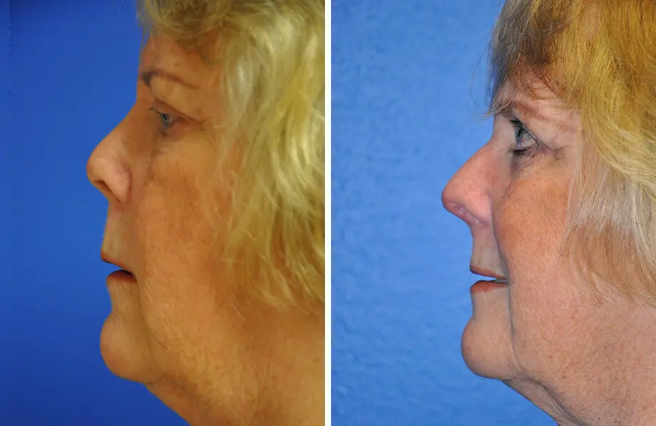 Revision Rhinoplasty Before and After Patient 1