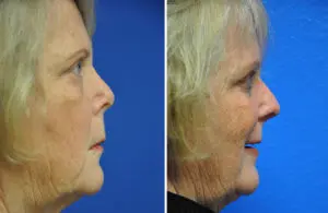 Revision Rhinoplasty Before and After Patient Thumbnail 4