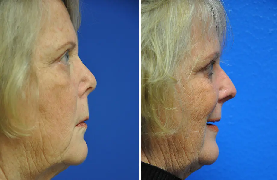 Revision Rhinoplasty Before and After Patient 4