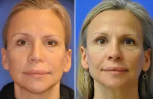 Revision Rhinoplasty Before and After Patient Thumbnail 3