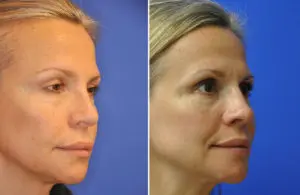Revision Rhinoplasty Before and After Patient Thumbnail 4