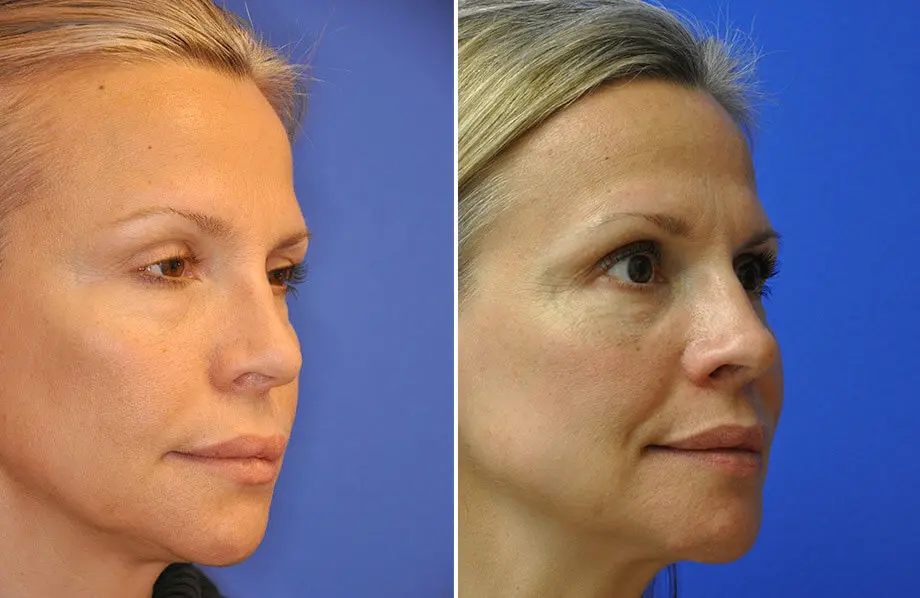 Revision Rhinoplasty Before and After Patient 4