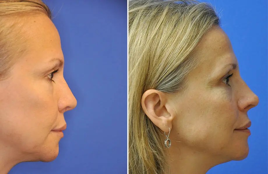 Revision Rhinoplasty Before and After Patient 2