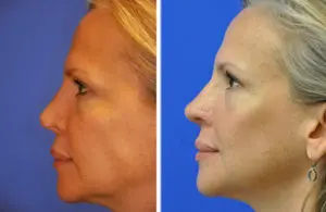 Revision Rhinoplasty Before and After Patient Thumbnail 1